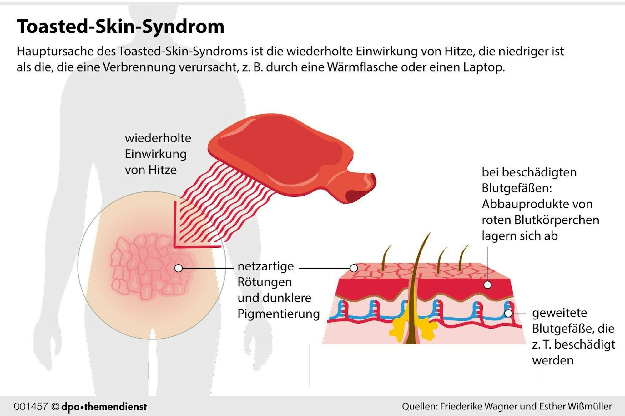 In einer Grafik wird erklärt, wie das Toasted-Skin-Syndrom entsteht