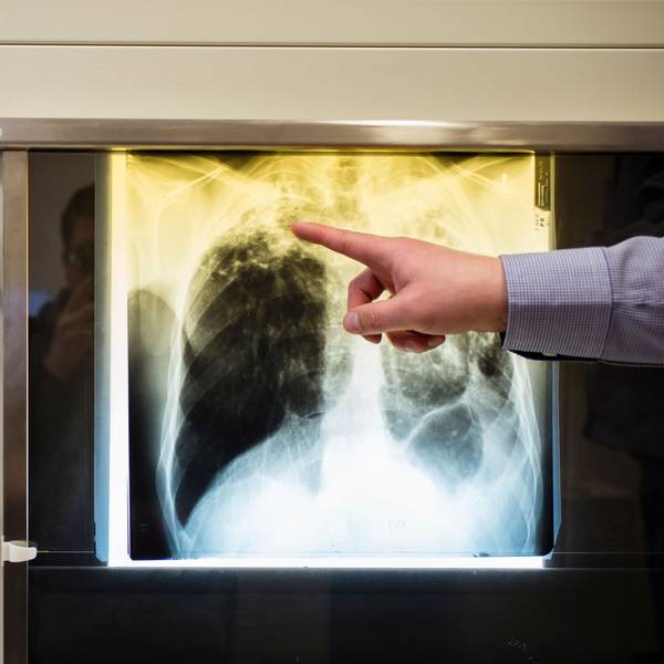 Ein Arzt zeigt einen Tuberkulose-Fall anhand eines Röntgenbildes in seinem Büro im Tuberkulosezentrum.