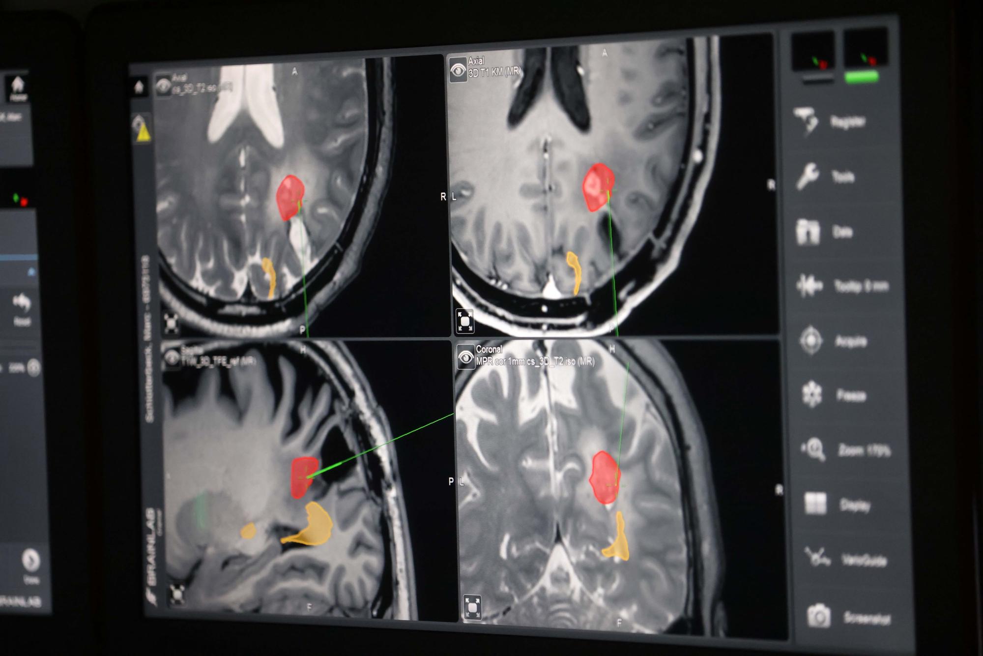 Der Tumor ist rot eingezeichnet, die Sehbahn gelb. Schwarz ist die Stelle der ersten Tumor-Entfernung.