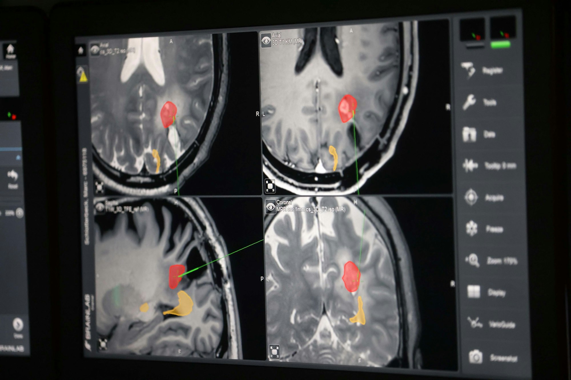 Der Tumor ist rot eingezeichnet, die Sehbahn gelb. Schwarz ist die Stelle der ersten Tumor-Entfernung.