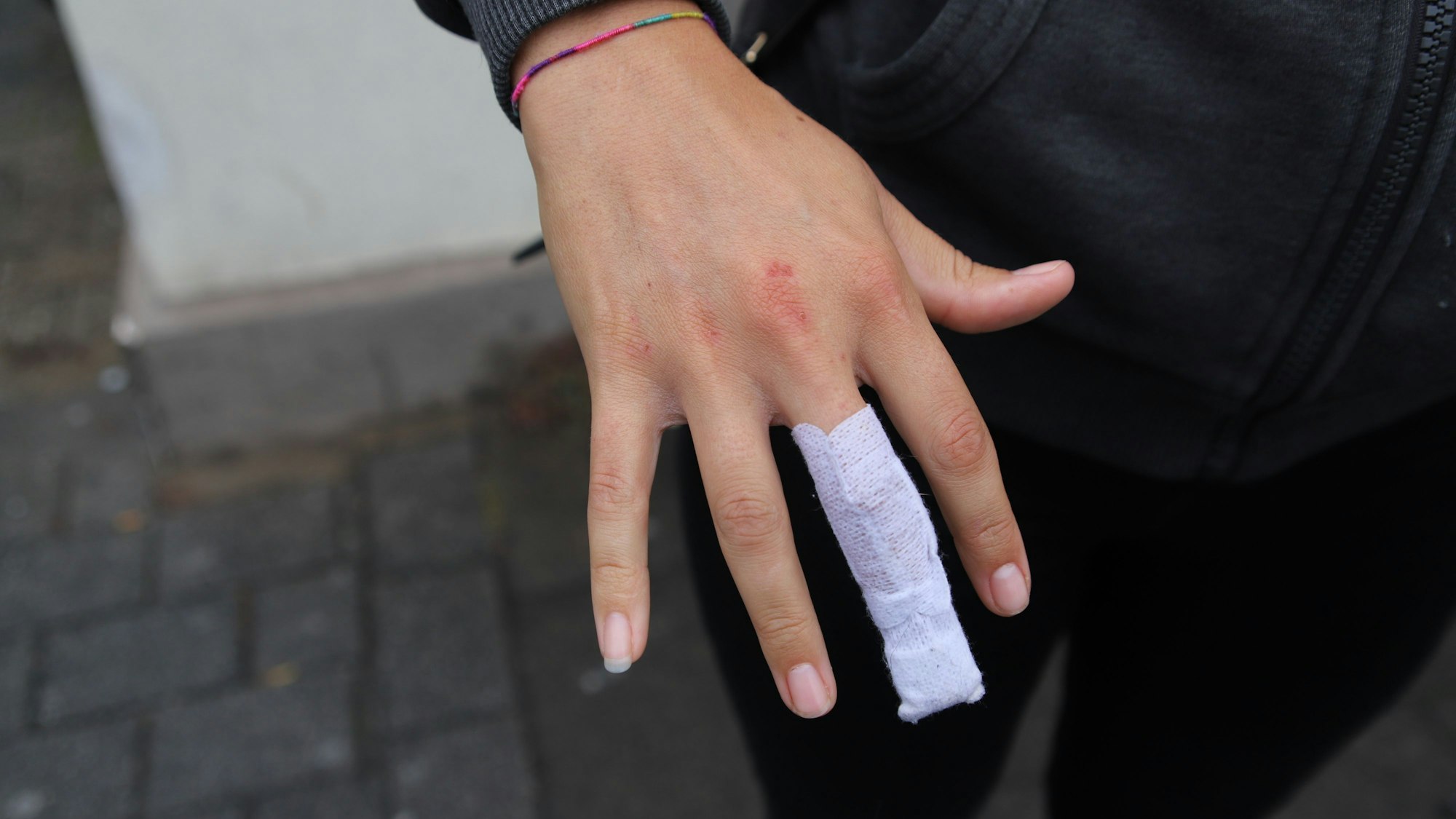 Julia Reich hält ihren lädierten Finger in die Kamera, wo sie von dem Rottweiler gebissen wurde.