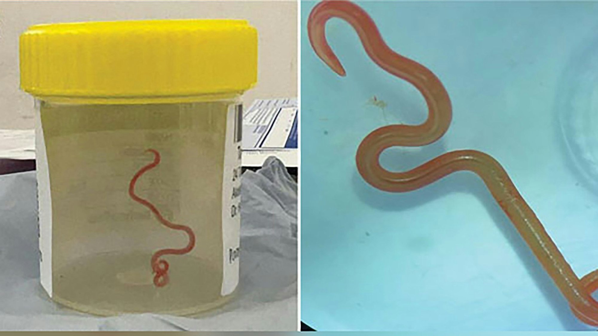 Das undatiertes Bild zeigt einen lebenden Spulwurm "Ophidascaris robertsi", der im Gehirn einer 64-jährigen Australierin gefunden wurde. In einem Krankenhaus in Canberra haben Ärzte einen lebendigen, acht Zentimeter langen Rundwurm aus dem Gehirn einer 64-jährigen Frau entfernt. Bei dem Parasiten handele es sich um die Spezies Ophidascaris robertsi, die normalerweise nur in Pythons vorkomme.