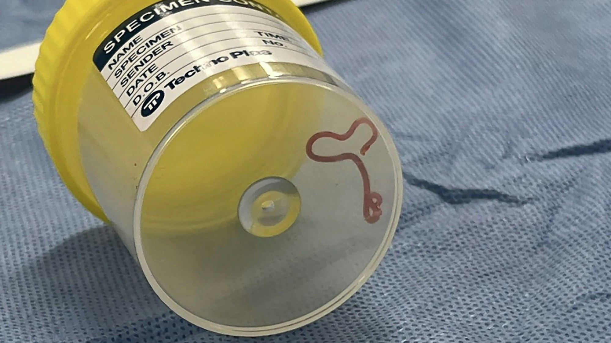 Dieses undatierte Foto, das von Canberra Health Services zur Verfügung gestellt wurde, zeigt einen Rundwurm in einem Probengefäß in einem Krankenhaus in Canberra. In einem Krankenhaus in Canberra haben Ärzte einen lebendigen, acht Zentimeter langen Rundwurm aus dem Gehirn einer 64-jährigen Frau entfernt.