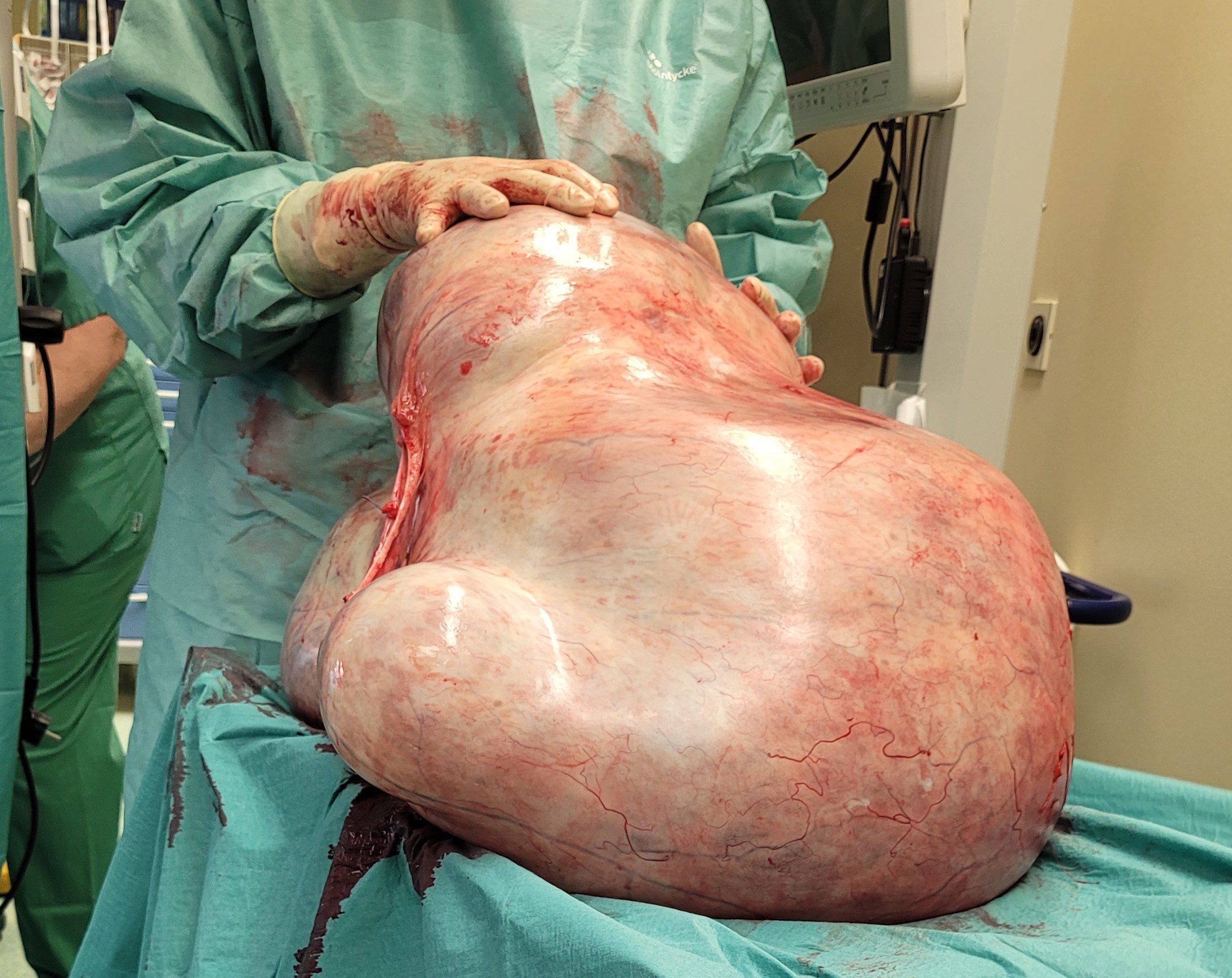 Ärzte der Uniklinik Magdeburg haben einer Frau einen 32 Kilogramm schweren Tumor entfernt.
