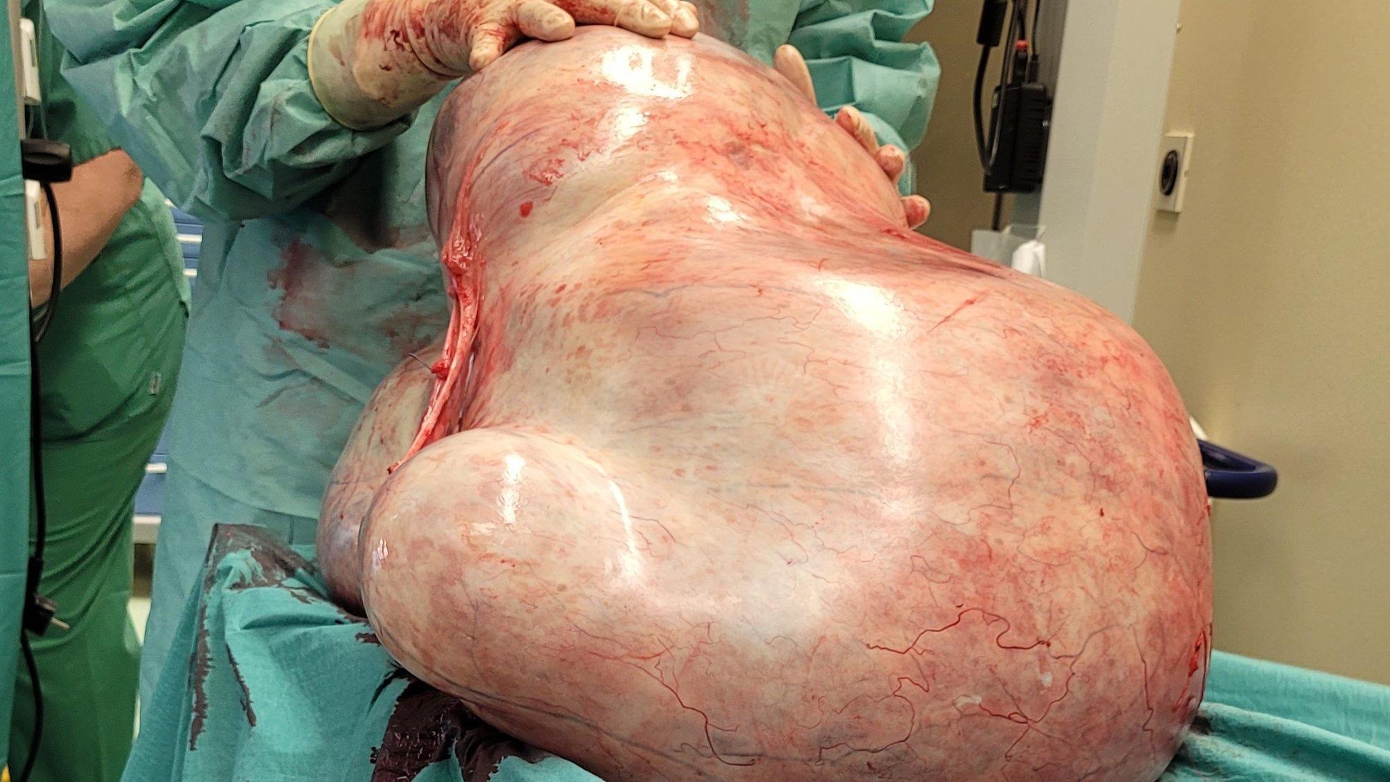 Ärzte der Uniklinik Magdeburg haben einer Frau einen 32 Kilogramm schweren Tumor entfernt.