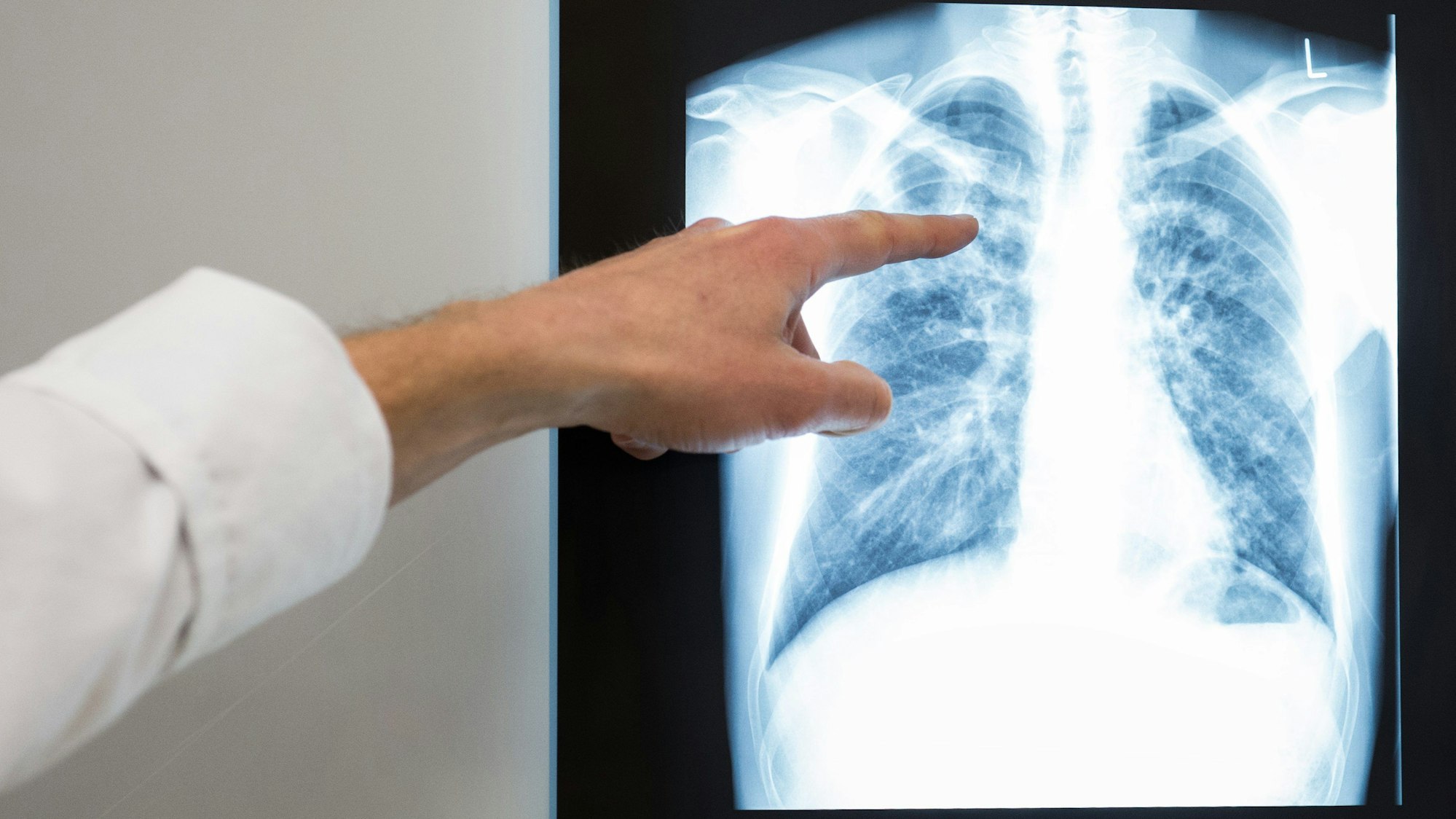 Ein Arzt zeigt im Vivantes Klinikum Neukölln auf das Röntgenbild einer Lunge.