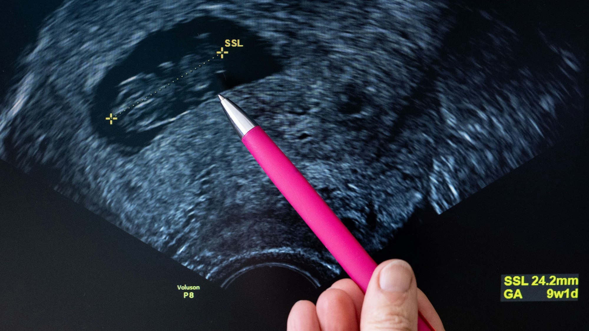 Eine Frauenärztin deutet auf den Kopf eines Fötus im Ultraschall.