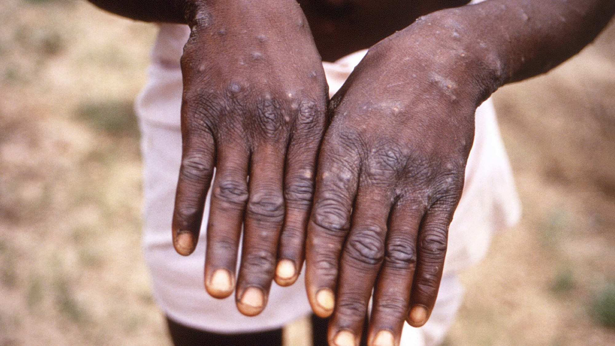 Dieses Bild aus dem Jahr 1997, das von der CDC während einer Untersuchung eines Affenpockenausbruchs in der Demokratischen Republik Kongo (DRC), dem früheren Zaire, zur Verfügung gestellt wurde, zeigt die Rückenflächen der Hände eines Affenpocken-Patienten, der den charakteristischen Ausschlag in der Erholungsphase zeigte.