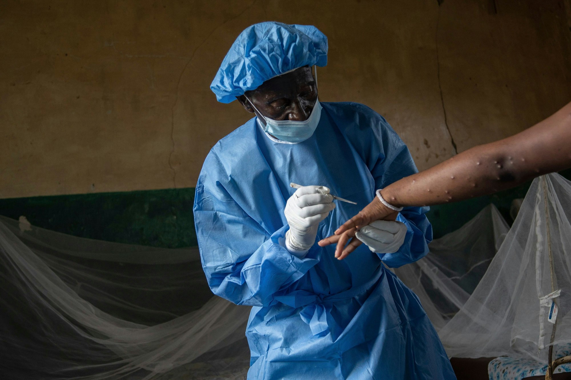 Ein Arzt behandelt eine an Mpox erkrankte Sexarbeiterin in einem Krankenhaus