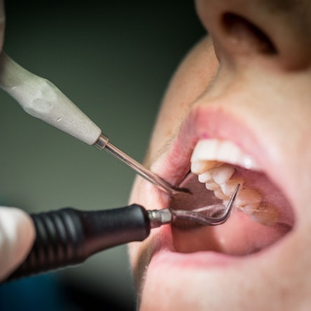 Wer eine Zahnbehandlung plant, sollte einen Wechsel der Zahnzusatzversicherung möglicherweise verschieben: Anstehende Behandlungen sind bei einem neuen Versicherer in der Regel nicht mitversichert.