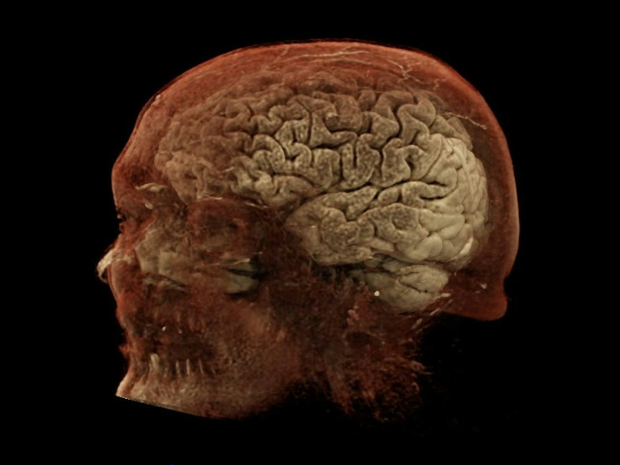 3-D-Rekonstruktion des Gehirns von Magnus Heier