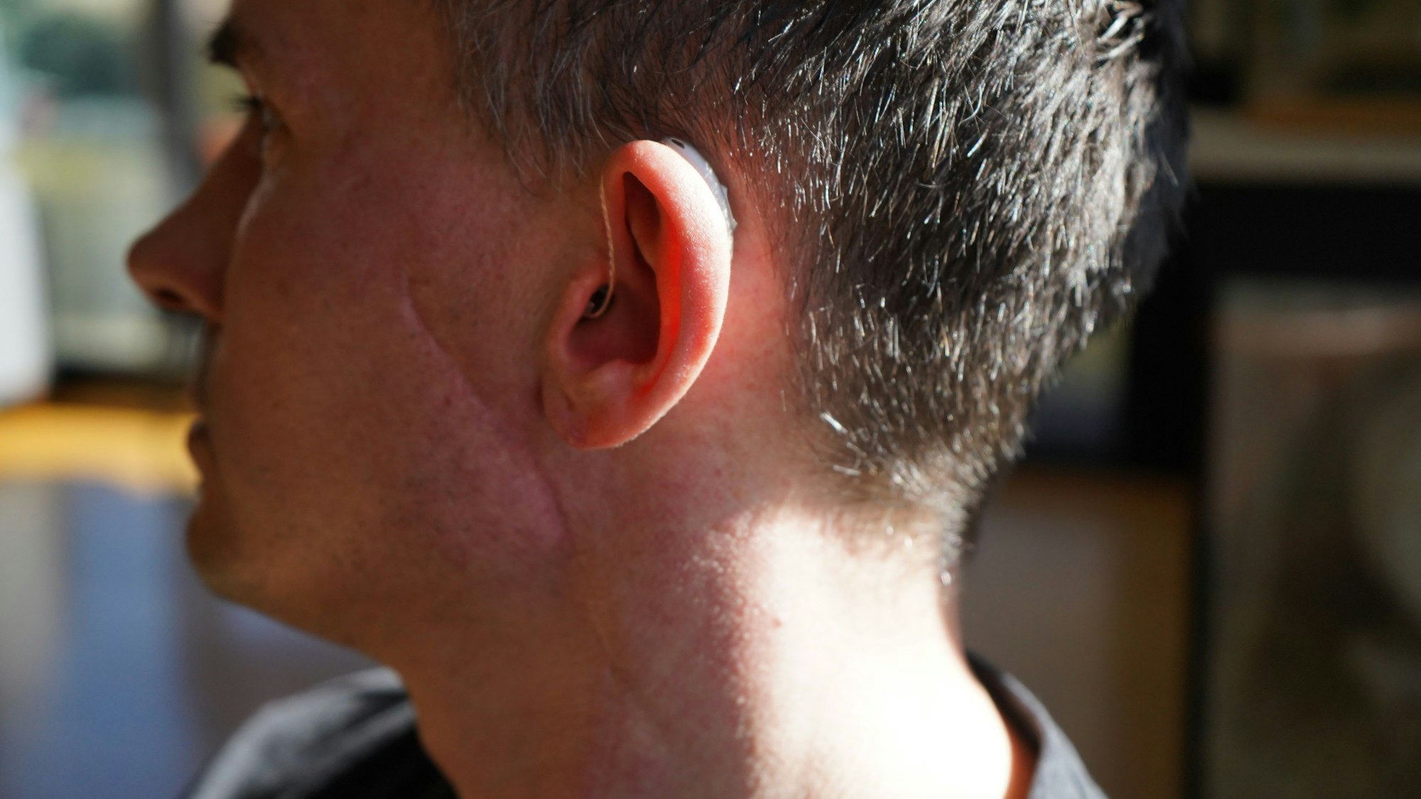 Das Foto zeigt einen Mann im Profil mit einer Narbe am Hals.