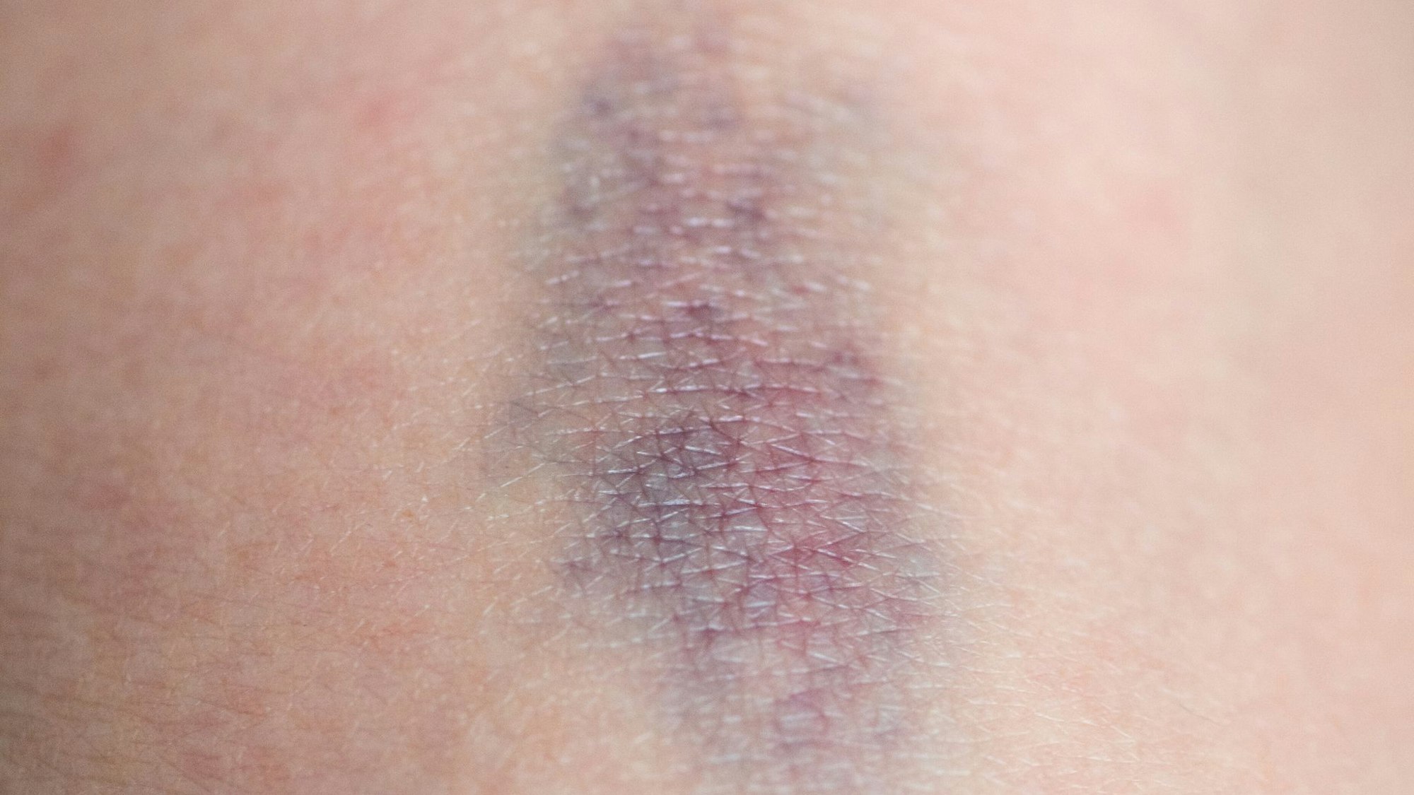 Wenn bereits leichte Stöße häufig zu blauen Flecken führen, kann das auf eine Störung der Blutgerinnung hinweisen.