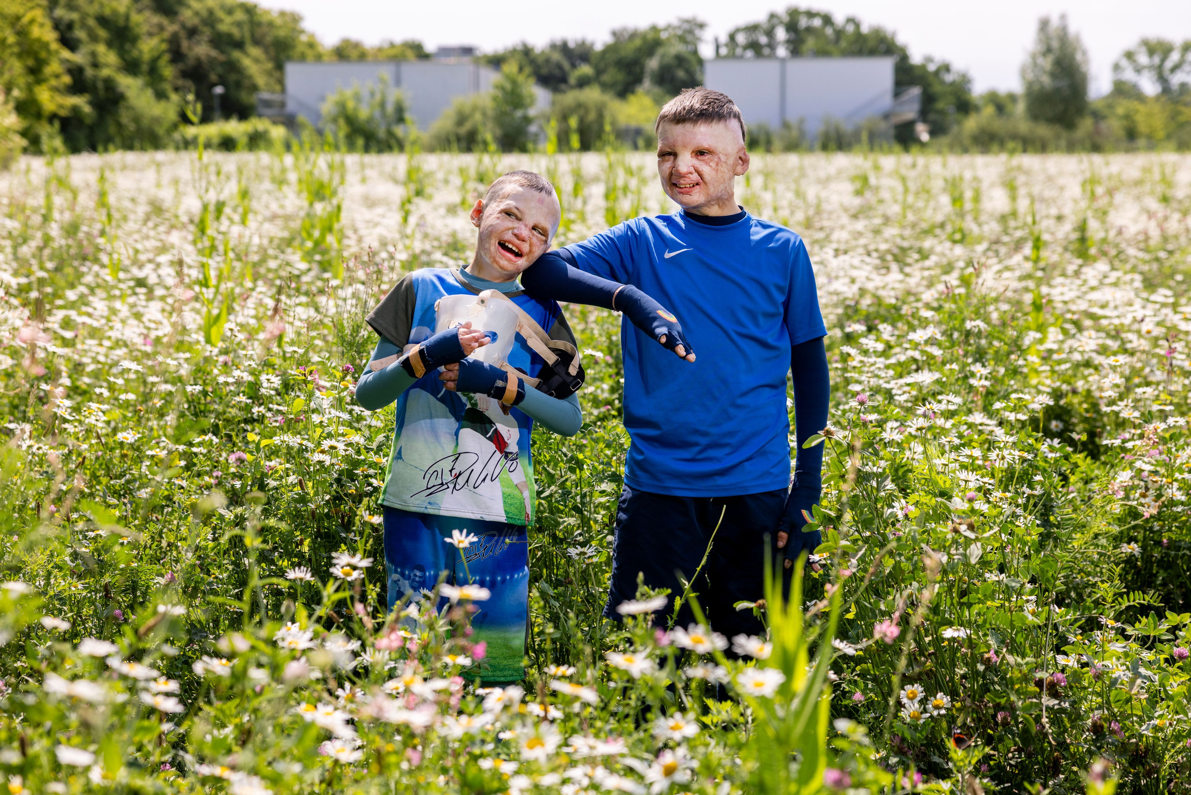 14.05.2025, Köln: Yurii und Yevhen aus der Ukraine wurden durch eine Explosion einer Erdölraffinerie in der Ukraine schwerst verbrannt und in der Uniklinik Köln behandelt.
Im Bild v.l.n.r. Yurii und Yevhen.

Foto: Michael Bause