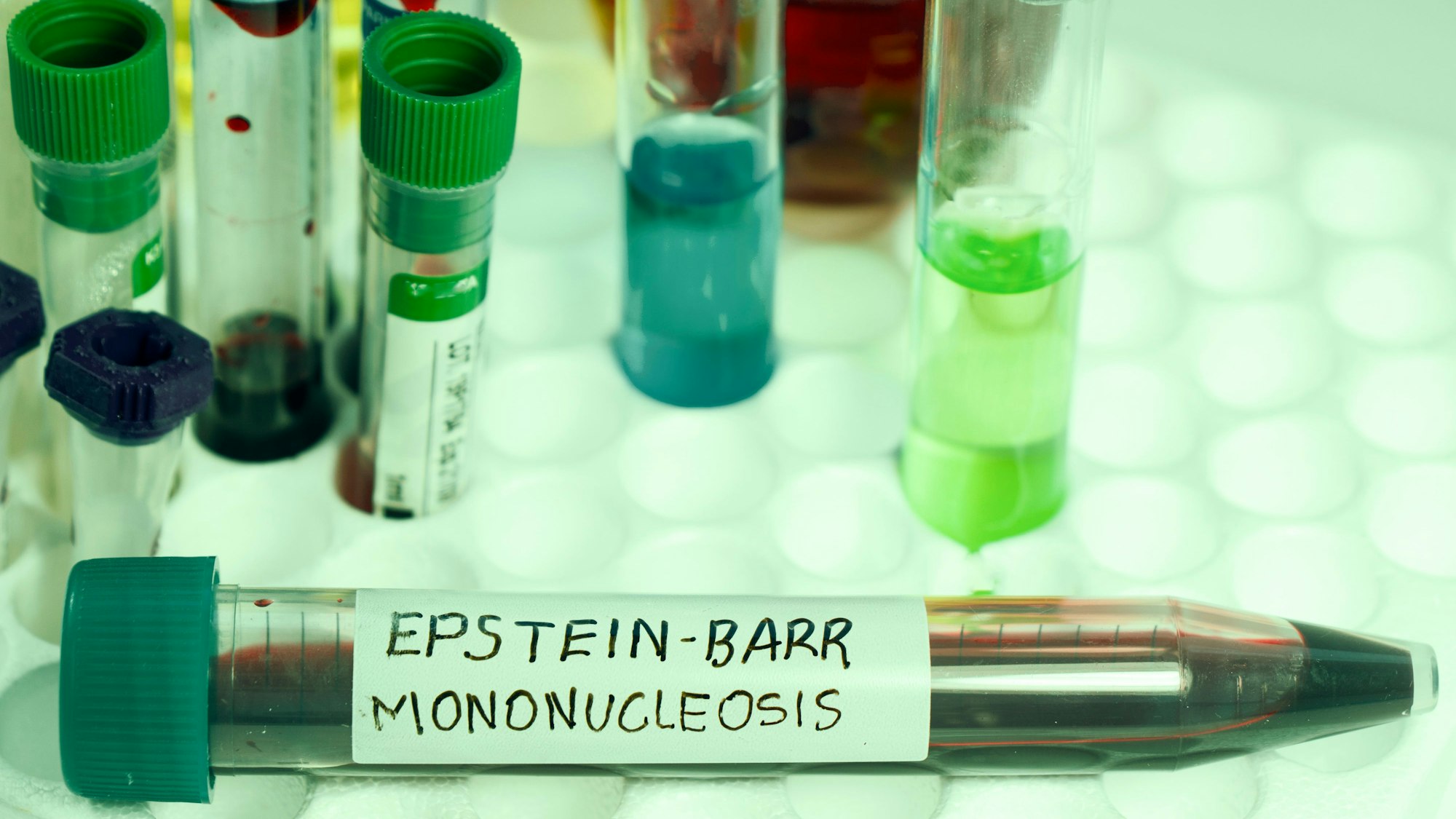 Blutprobe zur Analyse auf Epstein-Barr-Virus. Eine Infektion, die als möglicher Auslöser für Multiple Sklerose gilt.