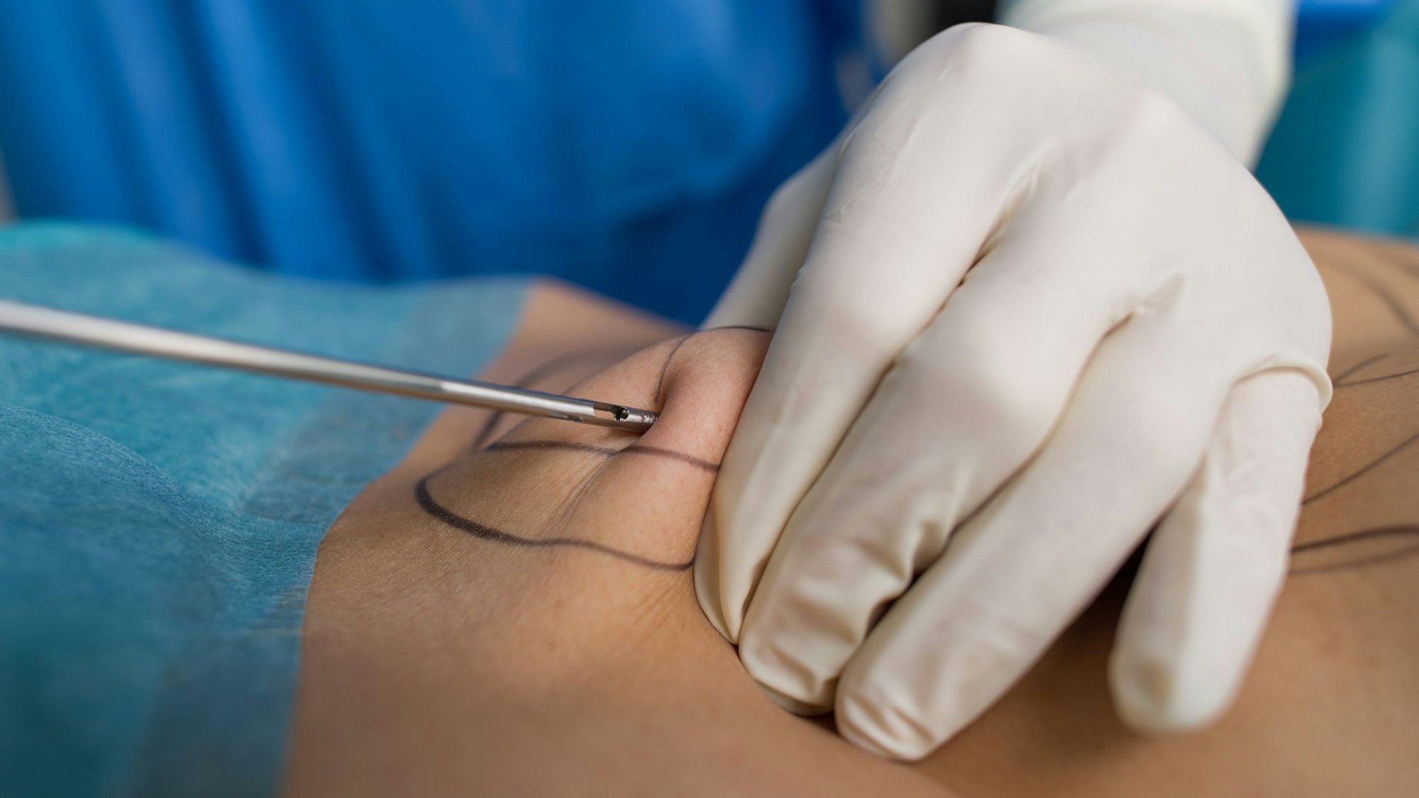 Unter bestimmten Voraussetzungen trägt die gesetzliche Krankenversicherung künftig die Kosten für eine Liposuktion.