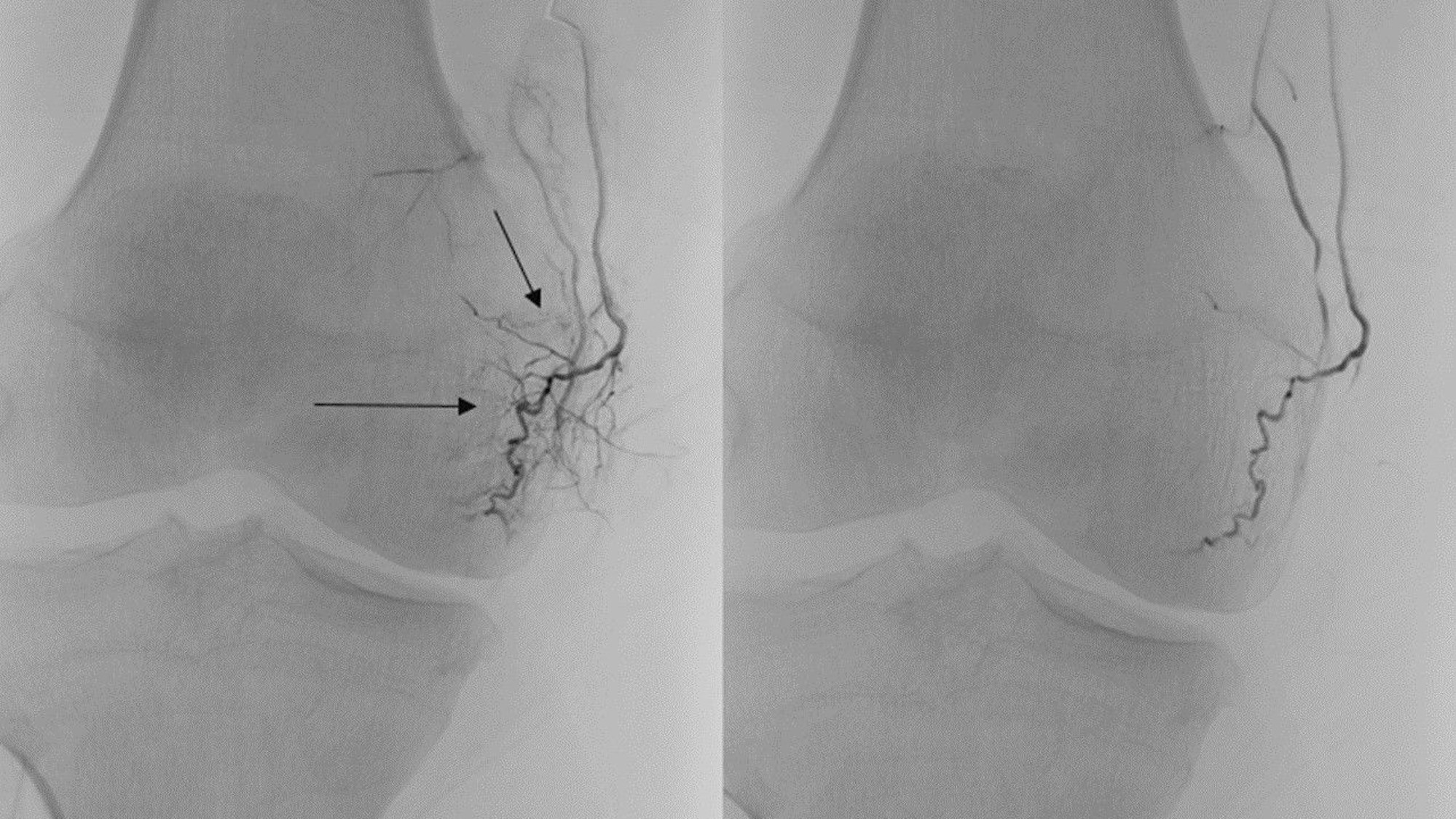 Bei einer TAPE wird die Blutzufuhr zu Entzündungsgewebe unterbrochen. Auf der rechten Seite der Röntgenaufnahme ist dieser Effekt deutlich zu sehen.