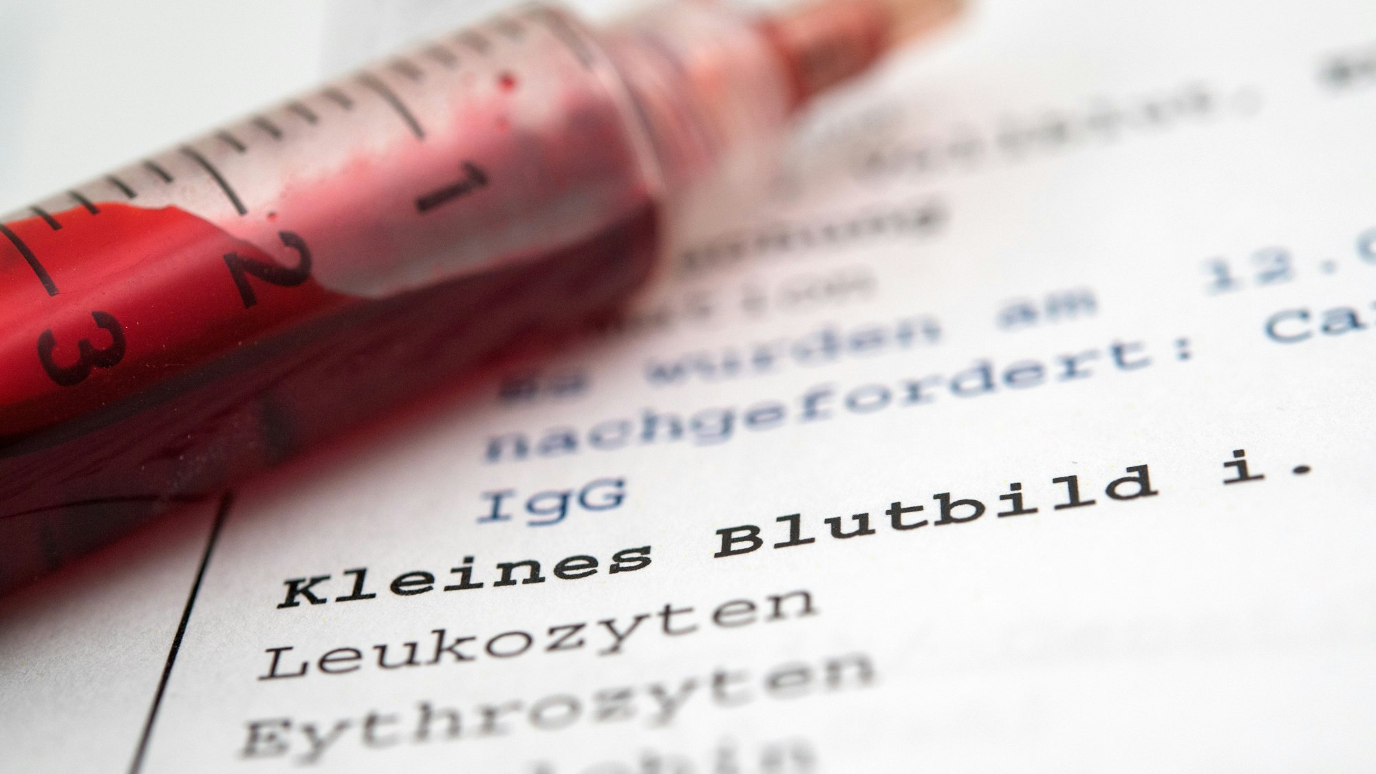 Über ein großes Blutbild lassen sich viele Krankheiten frühzeitig erkennen, so auch Diabetes.