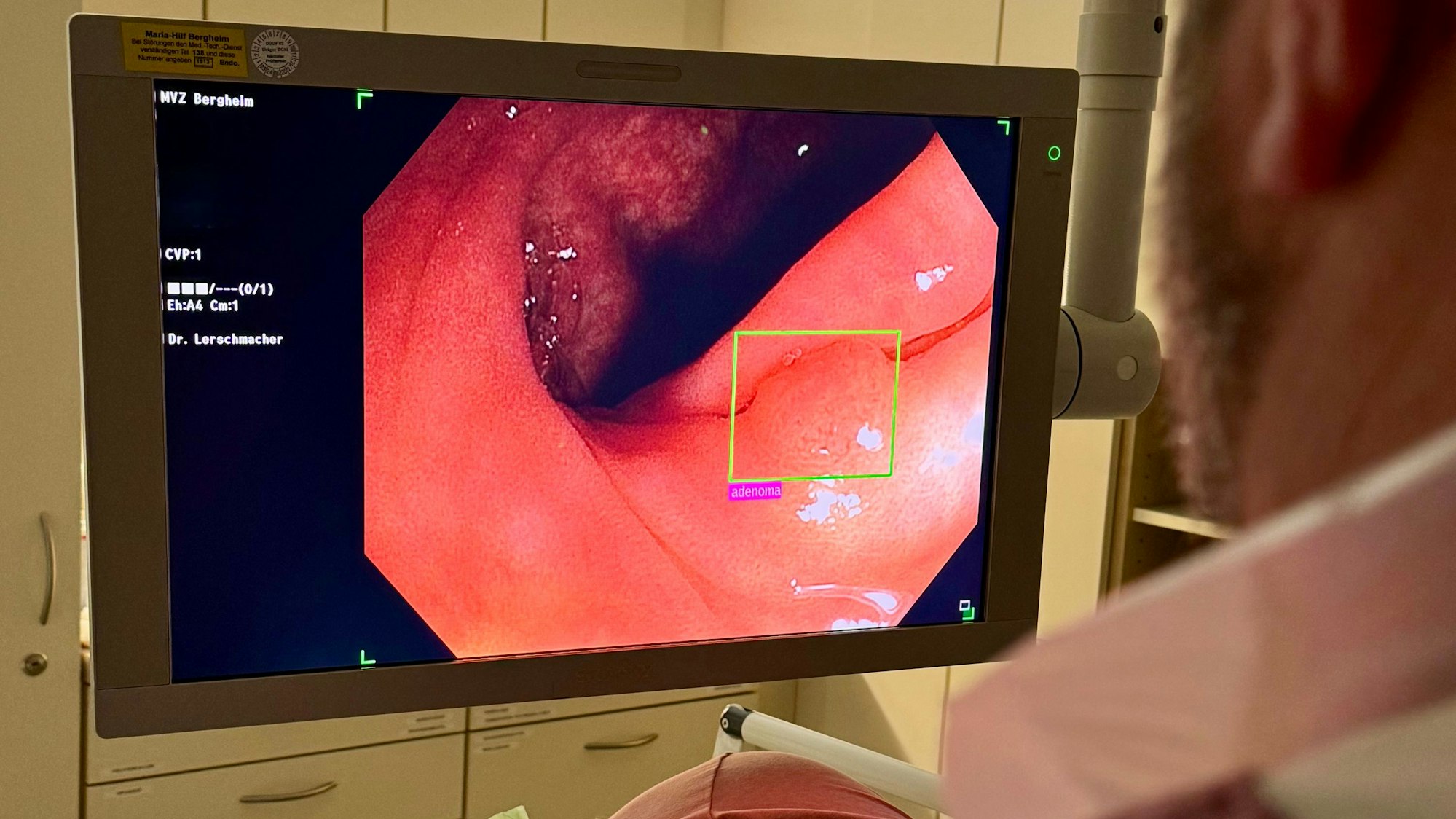 Das Bild zeigt den Bildschirm bei einer Darmspiegelung, ein grüner Kasten markiert eine auffällige Stelle.