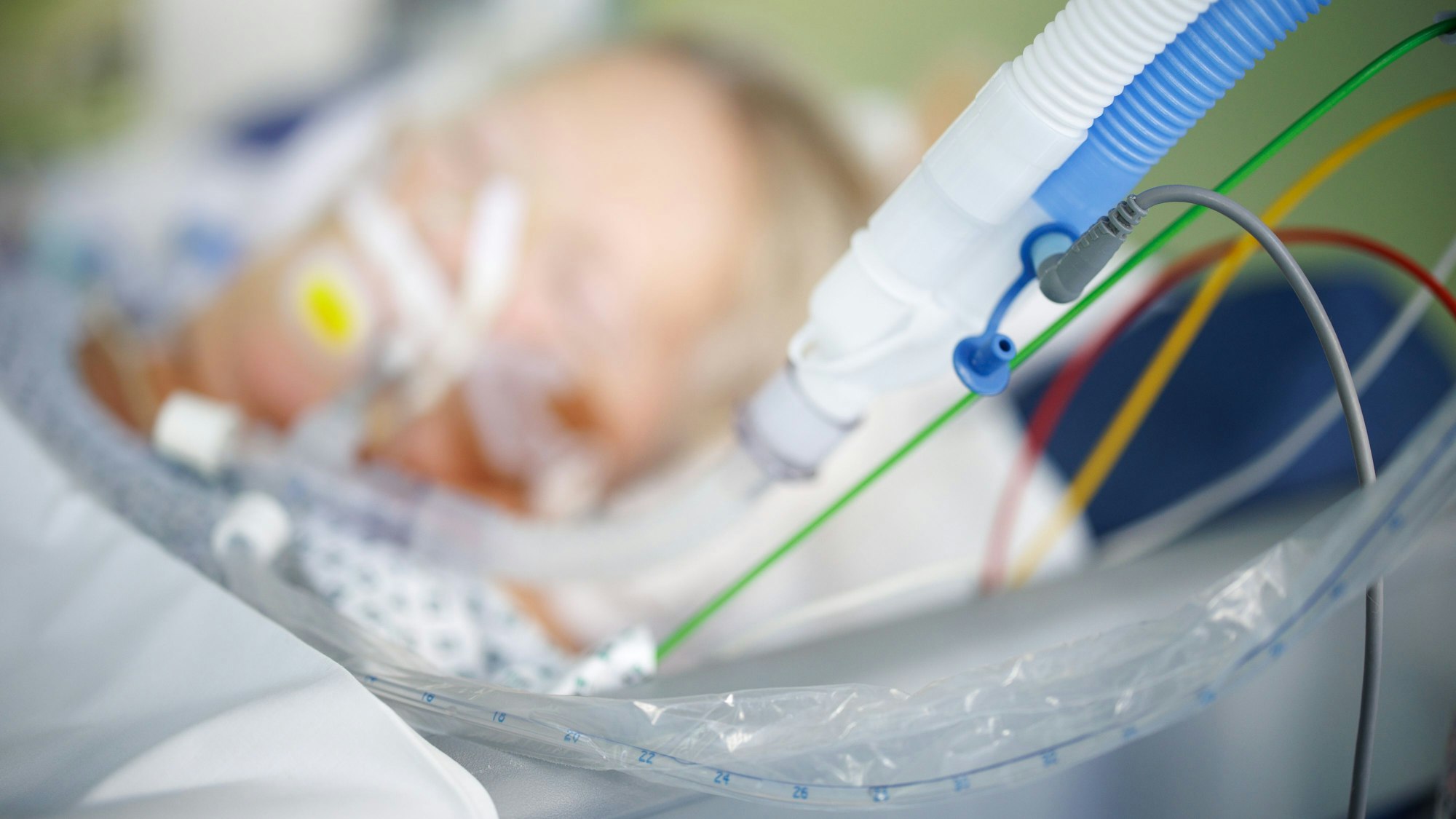 Beatmungsschläuche sind vor einem intubierten Patienten in einem Intensivbett-Zimmer zu sehen.