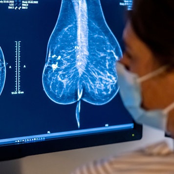 2023 wurden rund eine halbe Million Menschen in Deutschland mit Krebs diagnostiziert. (Symbolbild)