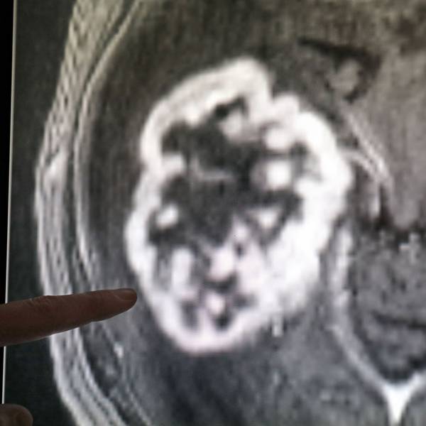 n der Diagnostik der Radiologie der Universitätsmedizin Rostock wird mit Hilfe der Magnetresonanztomographie ein Tumor festgestellt.