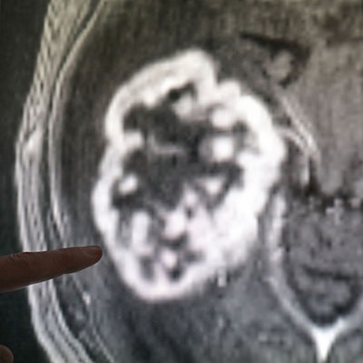 n der Diagnostik der Radiologie der Universitätsmedizin Rostock wird mit Hilfe der Magnetresonanztomographie ein Tumor festgestellt.