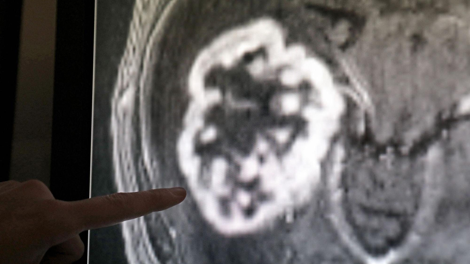 n der Diagnostik der Radiologie der Universitätsmedizin Rostock wird mit Hilfe der Magnetresonanztomographie ein Tumor festgestellt.