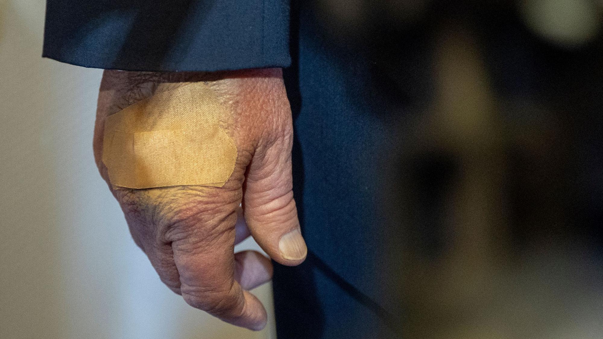 Die rechte Hand von US-Präsident Donald Trump ist bandagiert, als er mit Reportern spricht. (Archivbild)