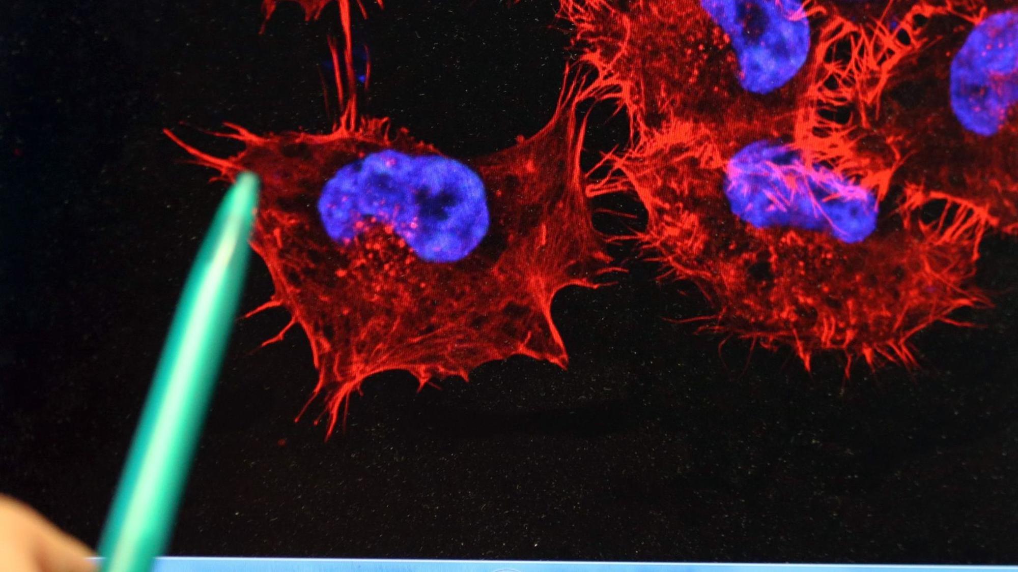 Studie: Hilft die mRNA-Impfung gegen Schwarzen Hautkrebs?