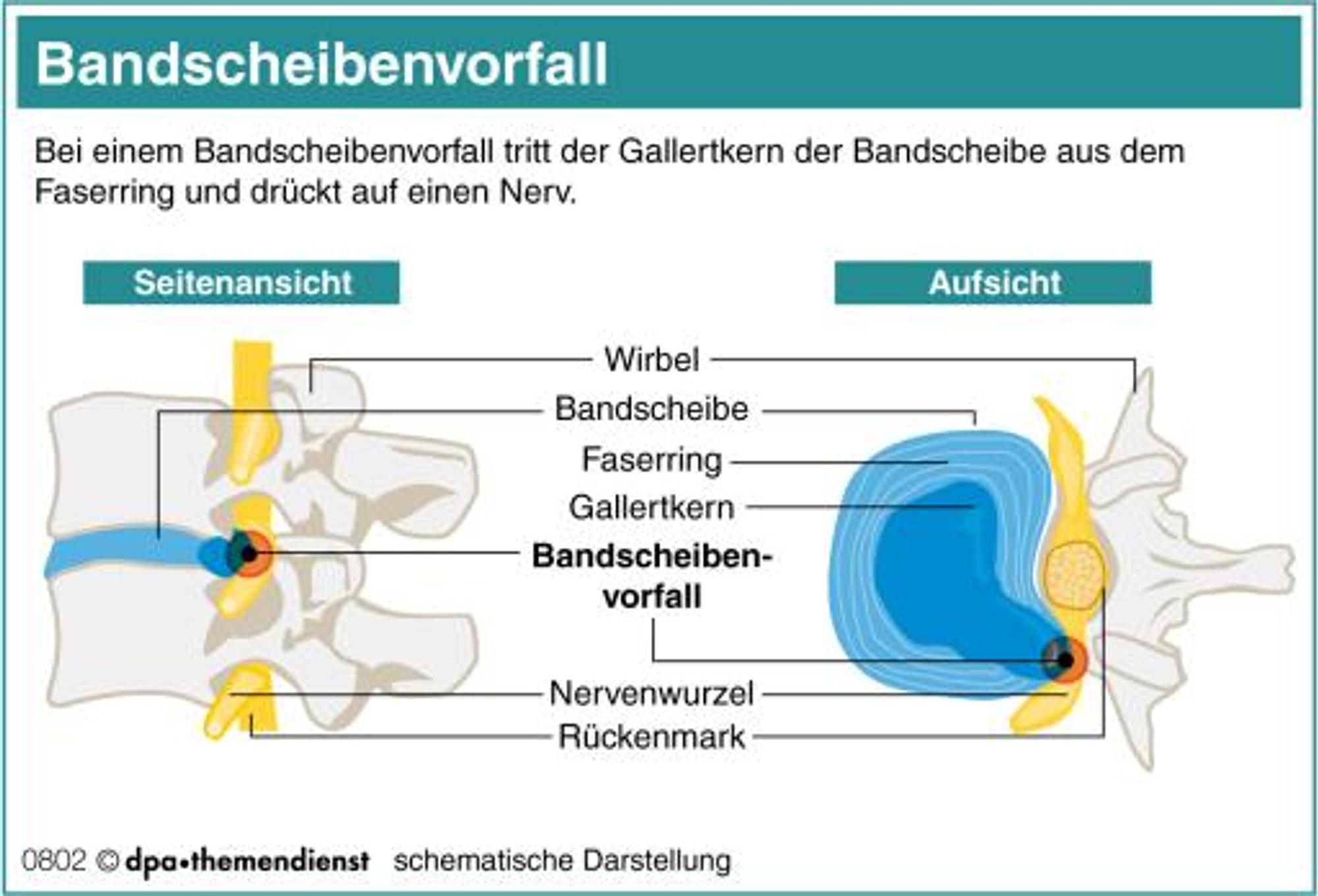 Bandscheibenvorfall_Grafik