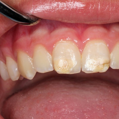 B_Kreidezaehne_240518