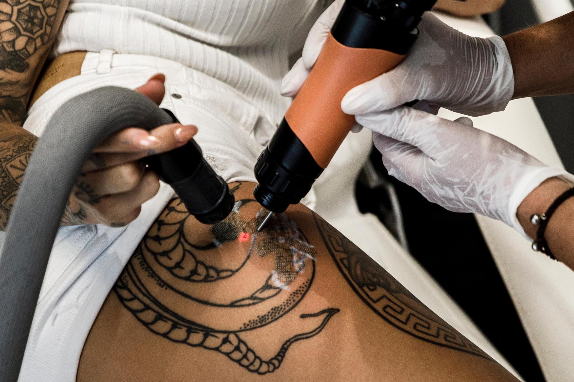 Tattoo Entfernung