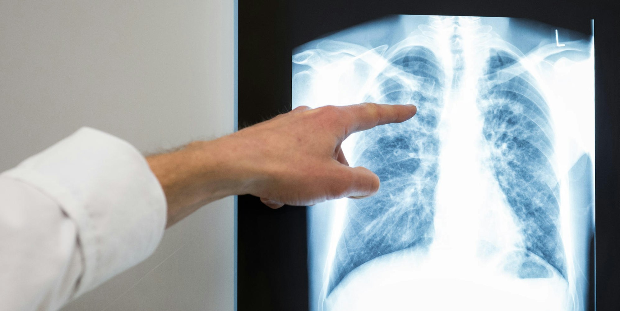 Lunge Symbolbild 060122