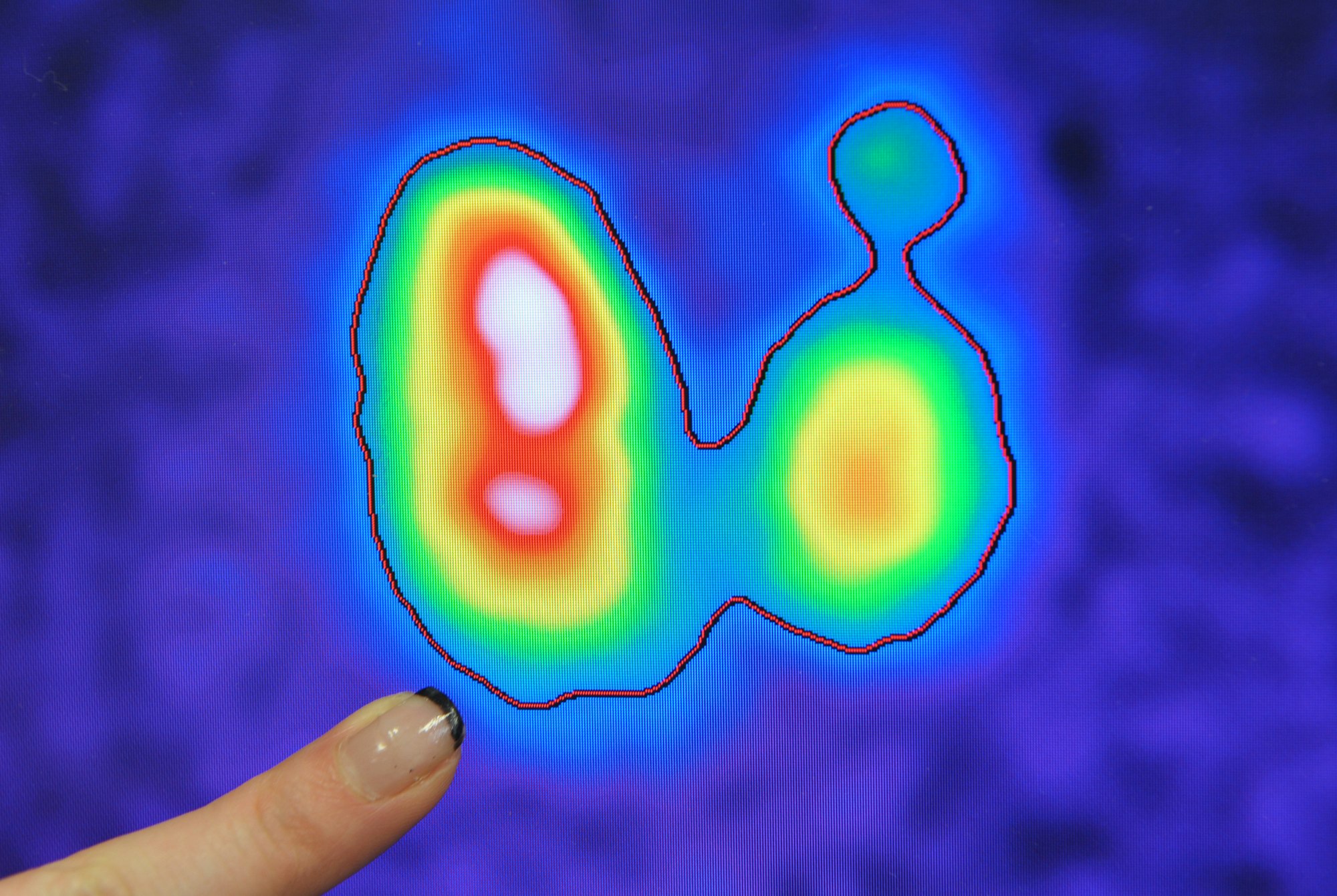 Erkrankte Schilddrüse