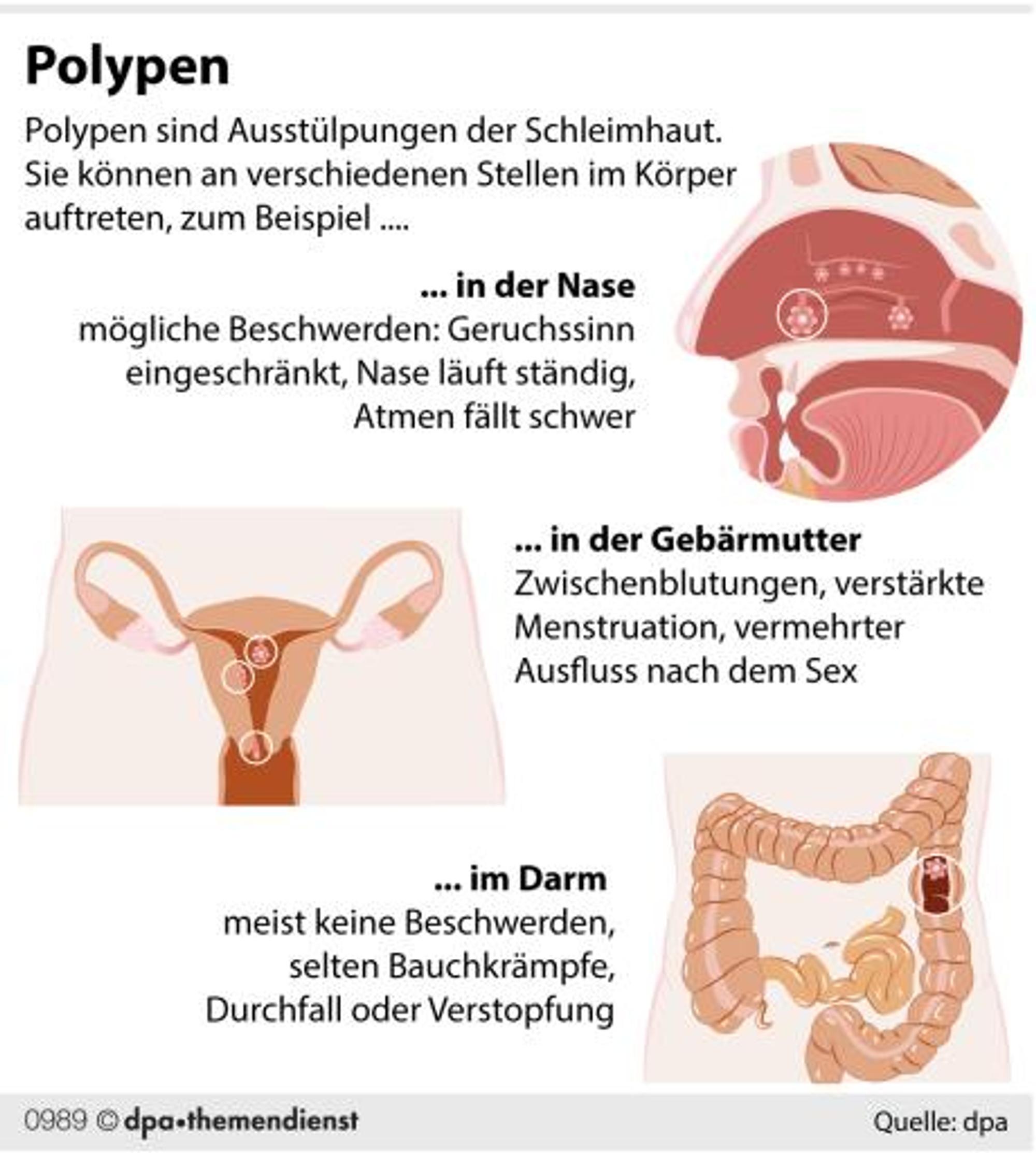 Polypen_Grafik