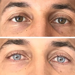 Augenfarbe durch Tattoo verändern