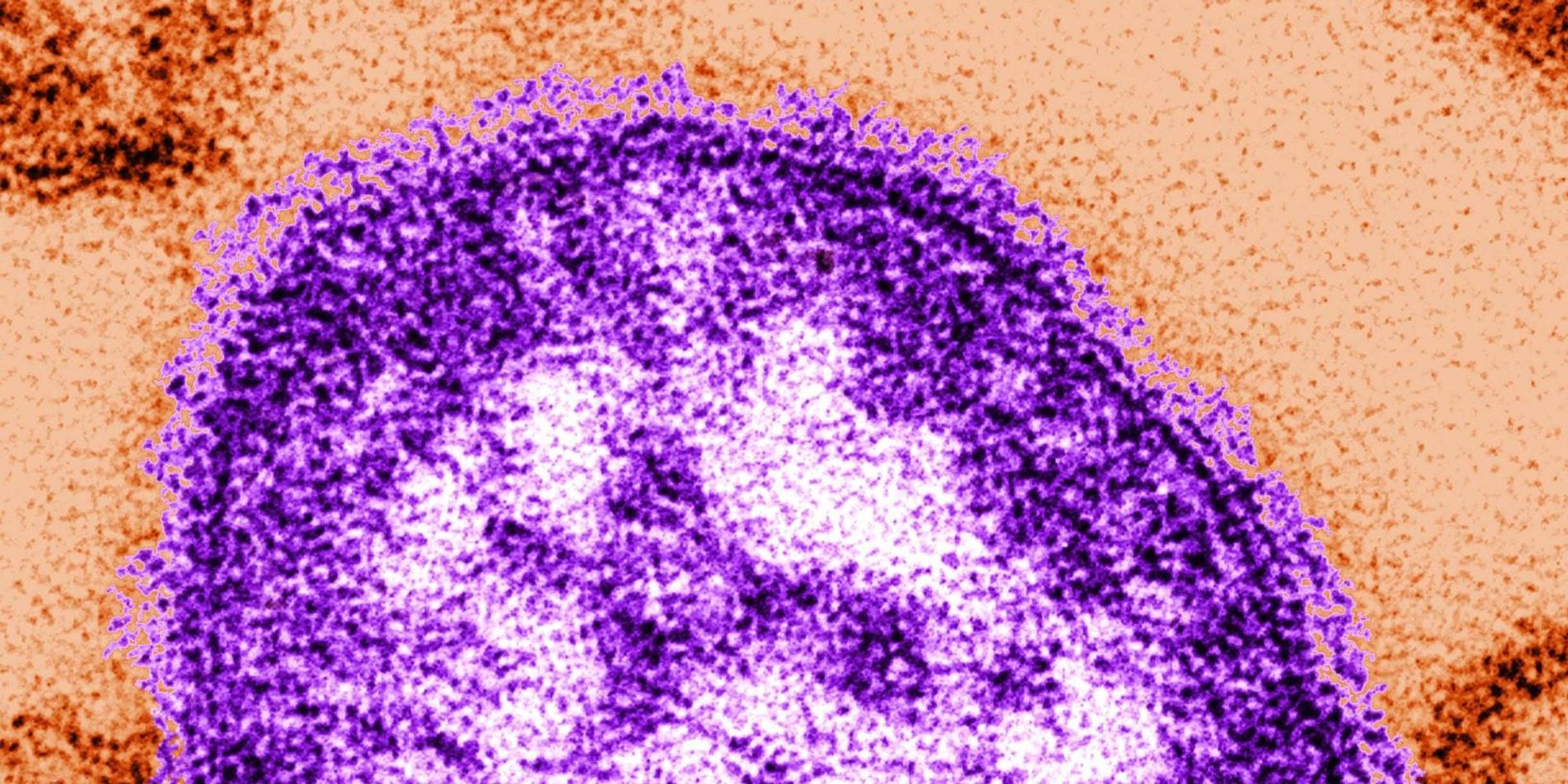 kr_masernvirus