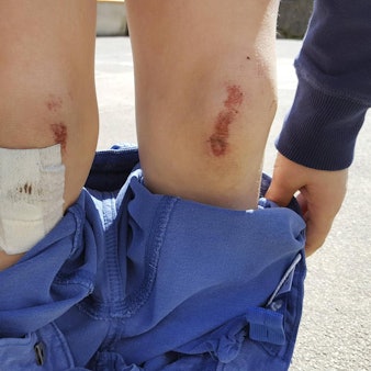 Mensch zeigt seine aufgeschürften_Knie