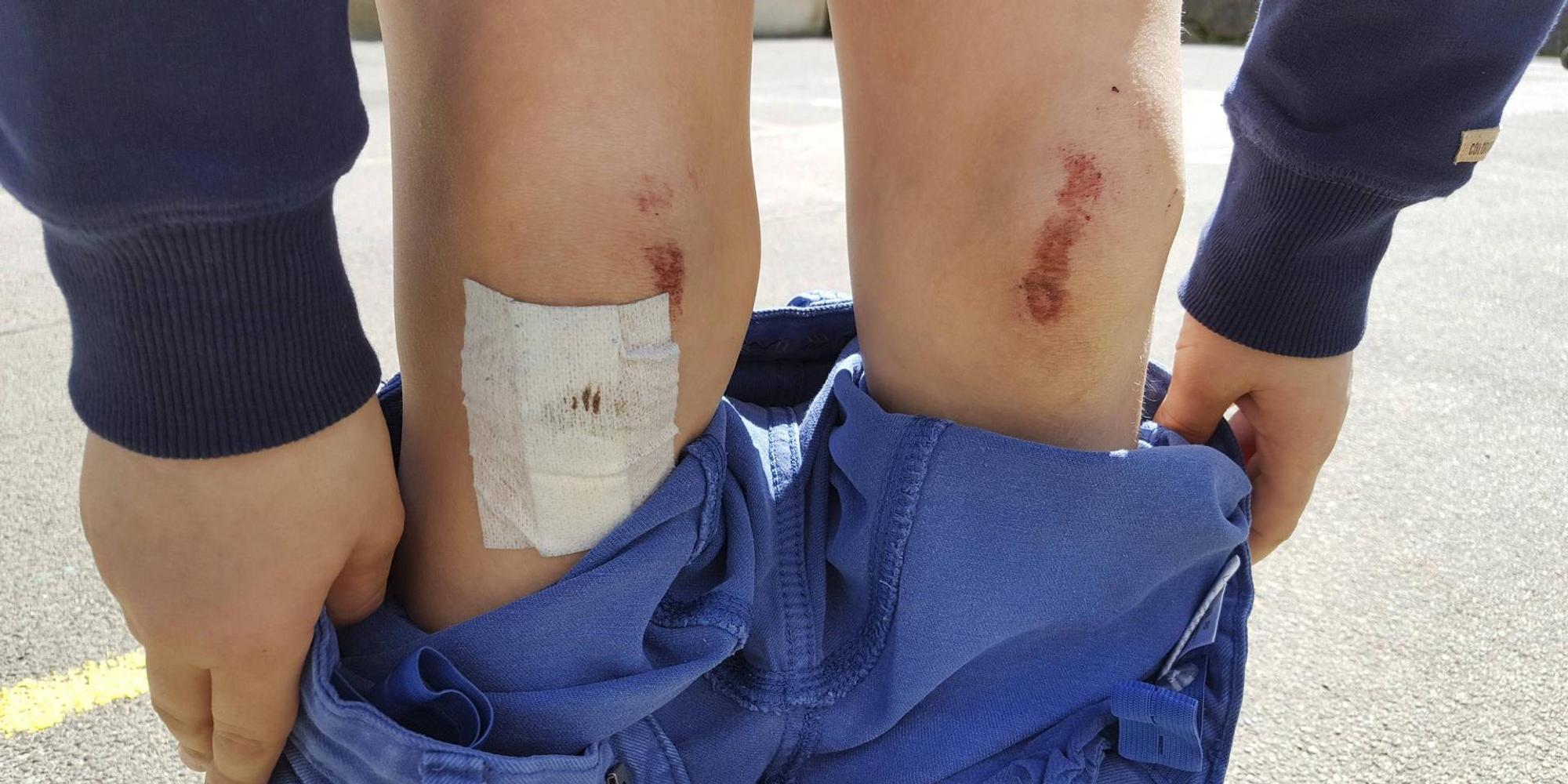 Mensch zeigt seine aufgeschürften_Knie