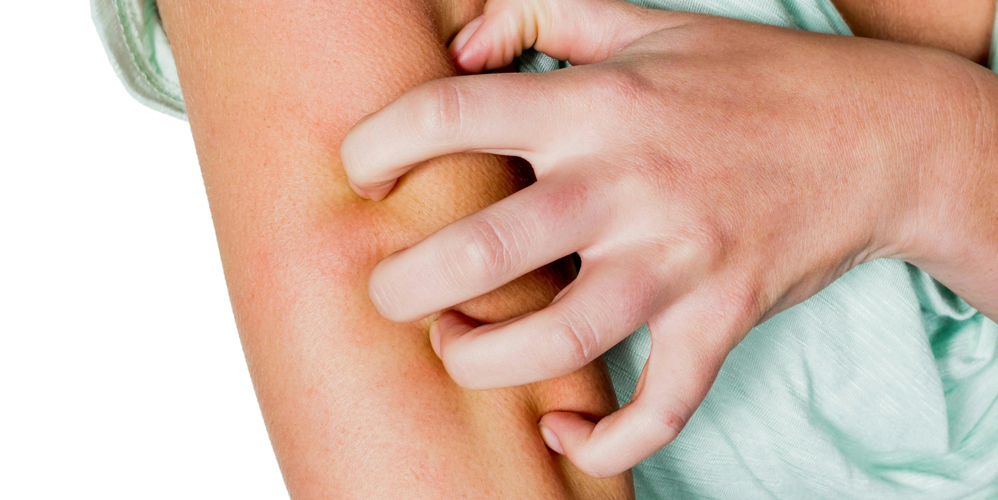 Insektenstich_Symbol_imago