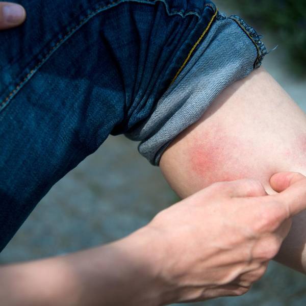 Bein mit roten Mückenstichen