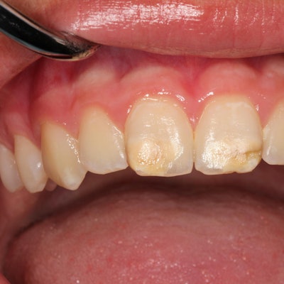 Bild von Kreidezähnen