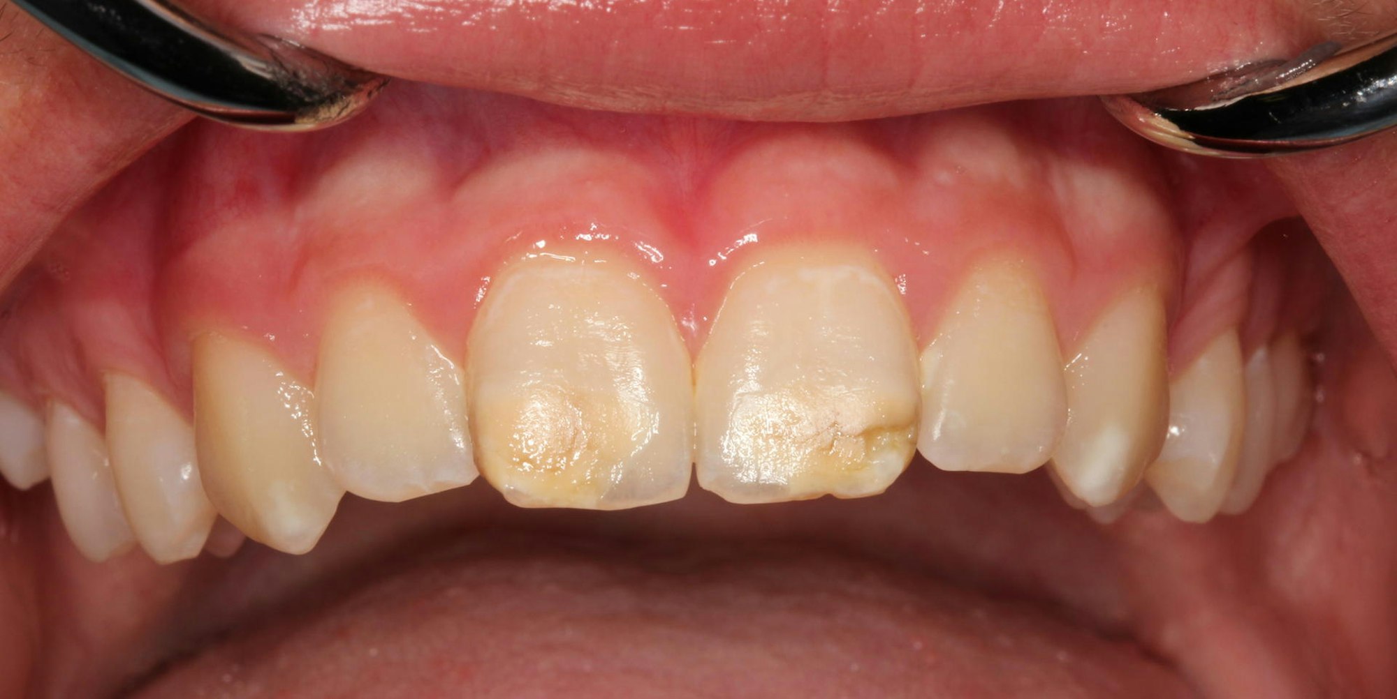 Bild von Kreidezähnen