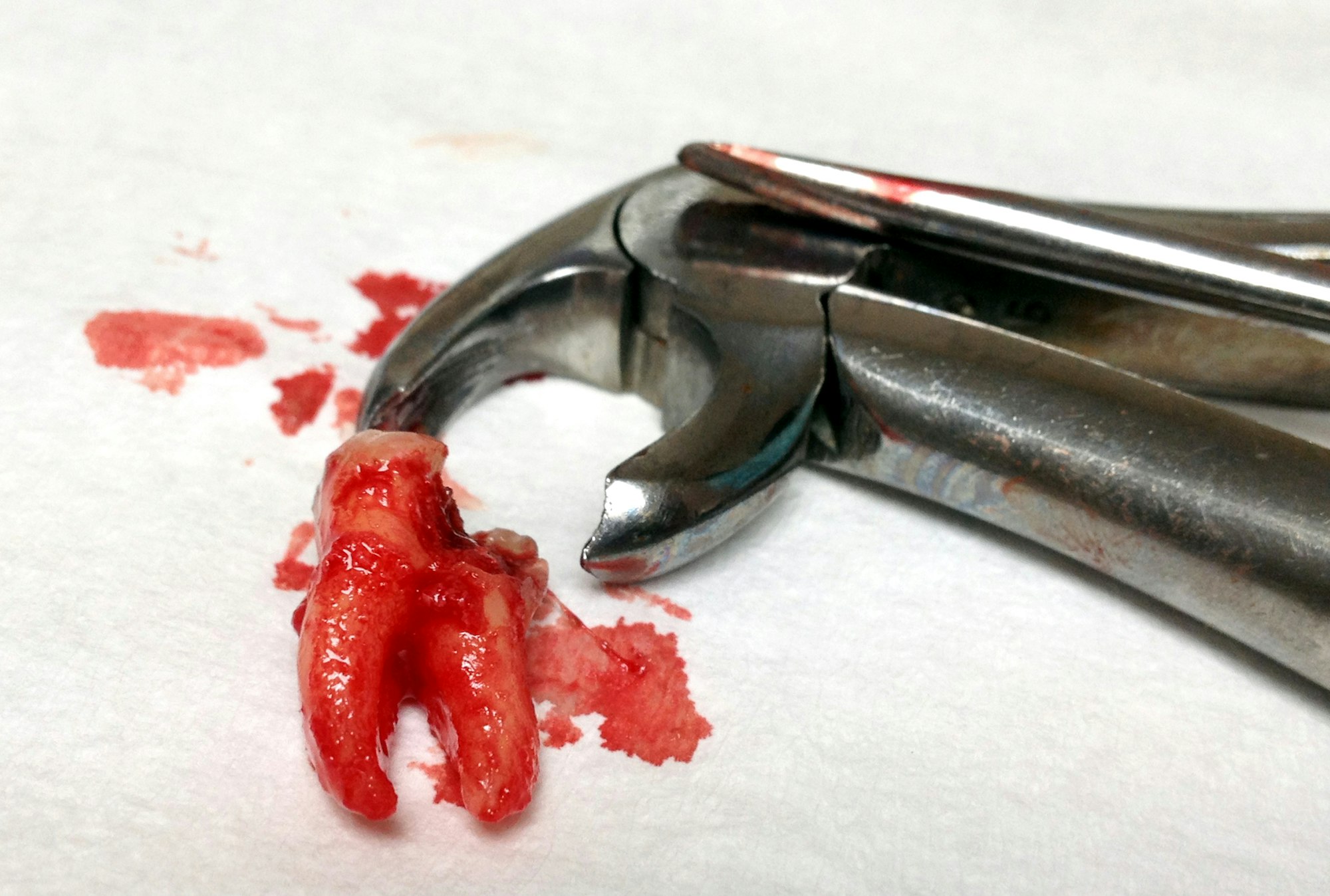 Weisheitszahn_34374128